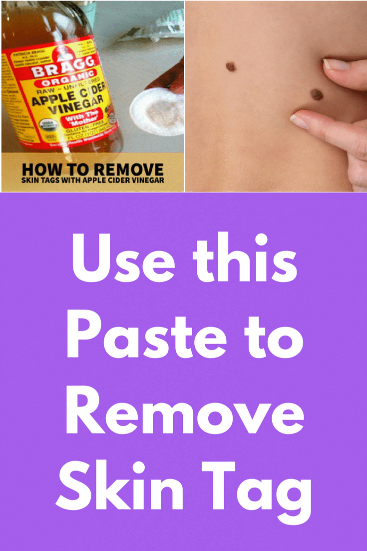 How To Remove Skin Tagsusing Home Remedies 64