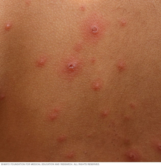 What Is Chickenpox Chickenpox Treatment Causes Symptoms 45