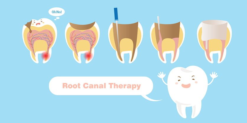 What To Eat After Root Canal 2894